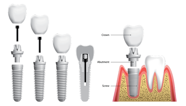 Implant graphic diagram